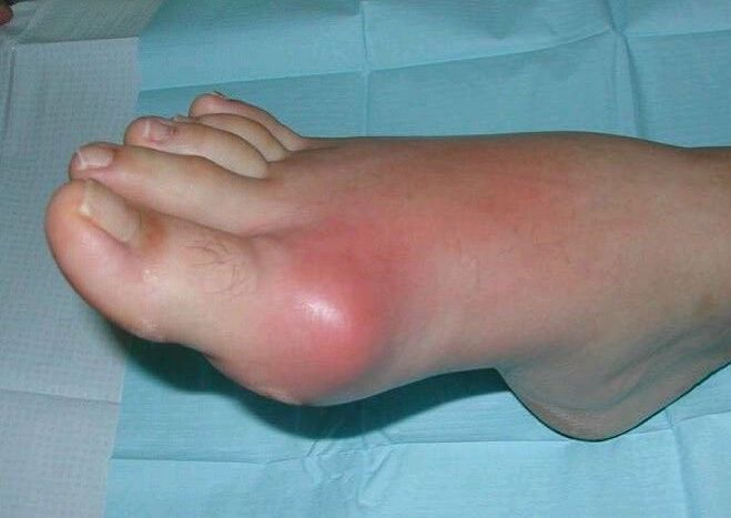 Клиничка слика на артритис на стапалото - оток и воспаление