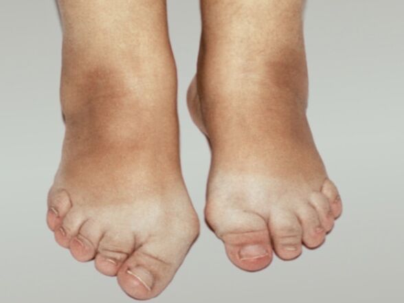 Остеоартритис на стапалото со тешка деформација на прстите
