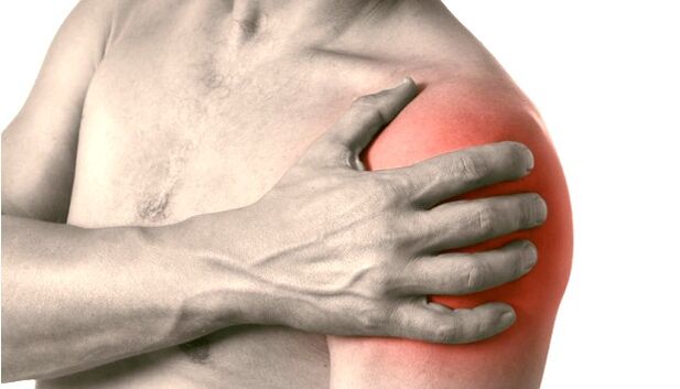 Отечено, црвено и зголемено рамо - симптоми на артроза на рамениот зглоб степен 2-3