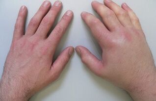 артралгија како причина за болка во зглобовите на прстите