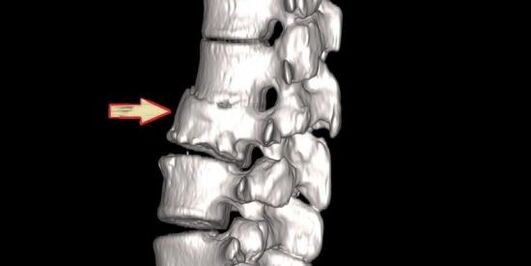 'рбетниот патологија како причина за болка во грбот
