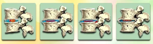 Фази на развој на osteochondrosis