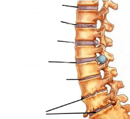 фази на развој на остеохондроза на 'рбетот