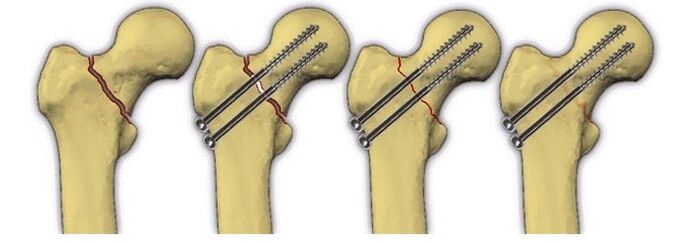 фиксација на коскеното тело со иглички за болка во зглобот на колкот