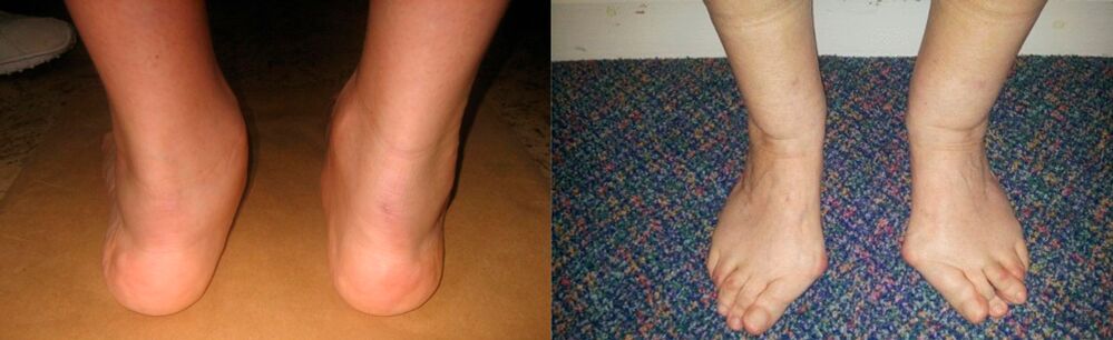Артроза на палецот на ногата и деформирачка артроза на глуждот