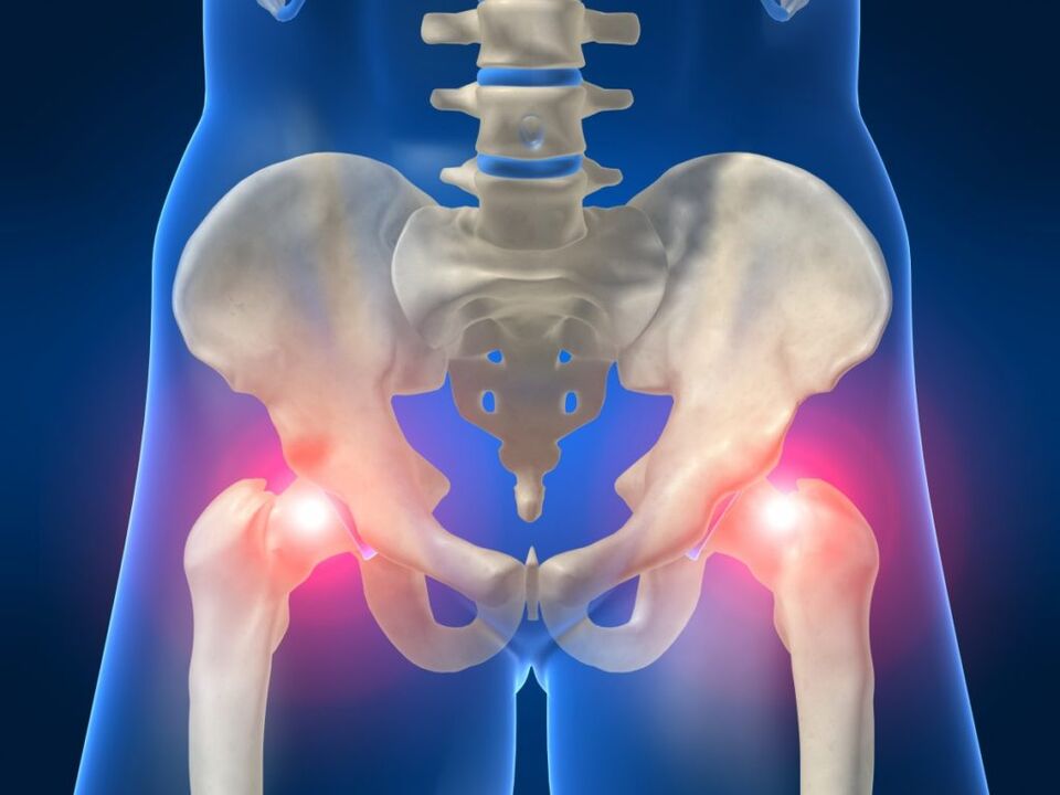Кај анкилозен спондилитис, билатералната болка во зглобот на колкот е вознемирувачка